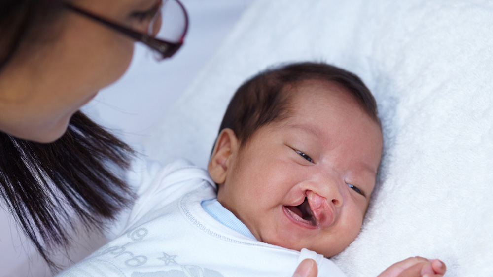 baby with cleft lip palate.
