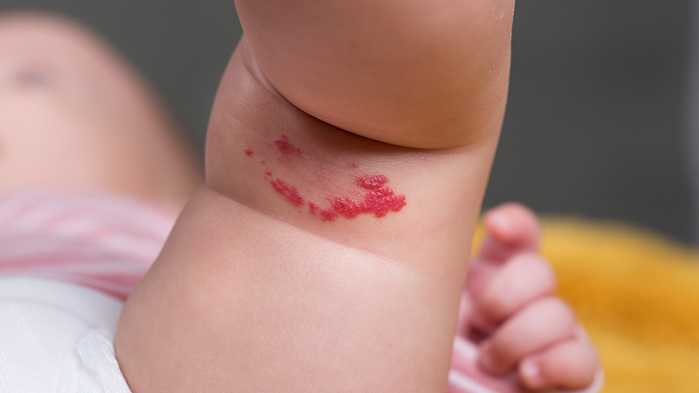 birthmark on baby's leg.