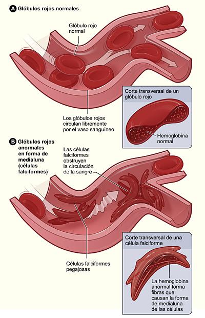 Normal Red Blood Cells and Sickle Cells - Spanish